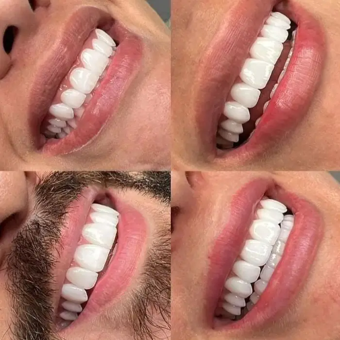 Faccette Dentali su Misura