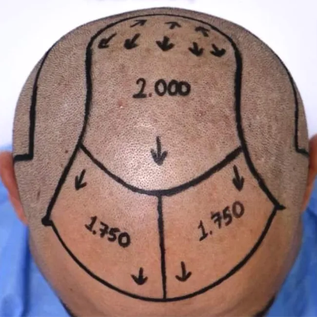 Trapianto di Capelli da 3,500 a 6,000 innesti
