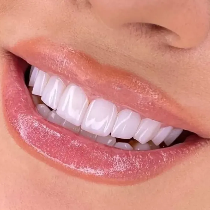 Sbiancamento Dentale Professionale